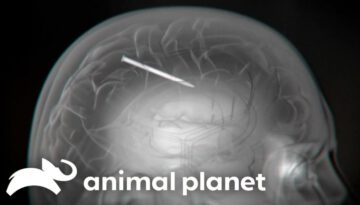 A Man Has A Whole Nail Stuck In His Brain!